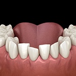 Illustration of a crossbite