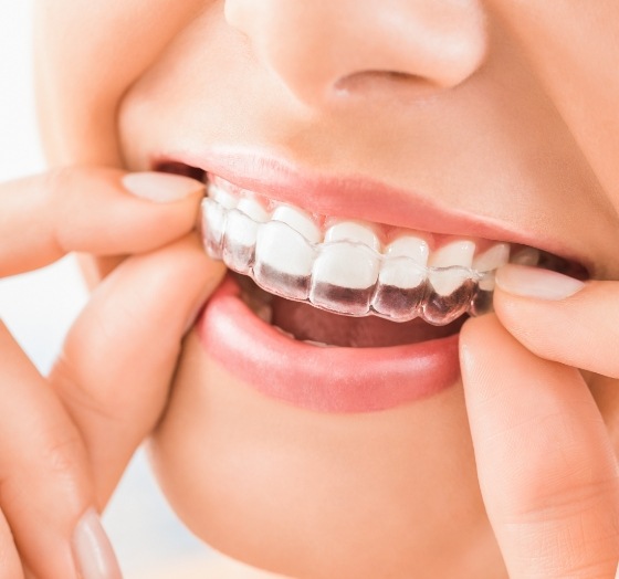 Closeup of patient placing a Nyce smile aligner