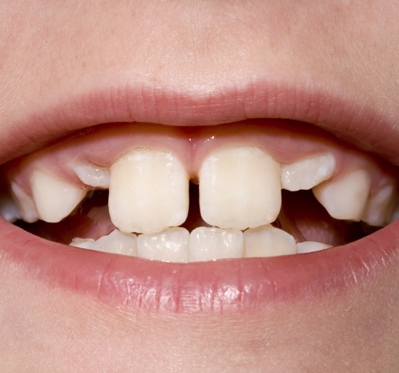 Closeup of child's smile before phase one orthodontics