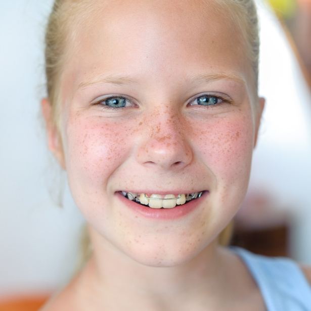 Preteen girl with pediatric orthodontics appliance