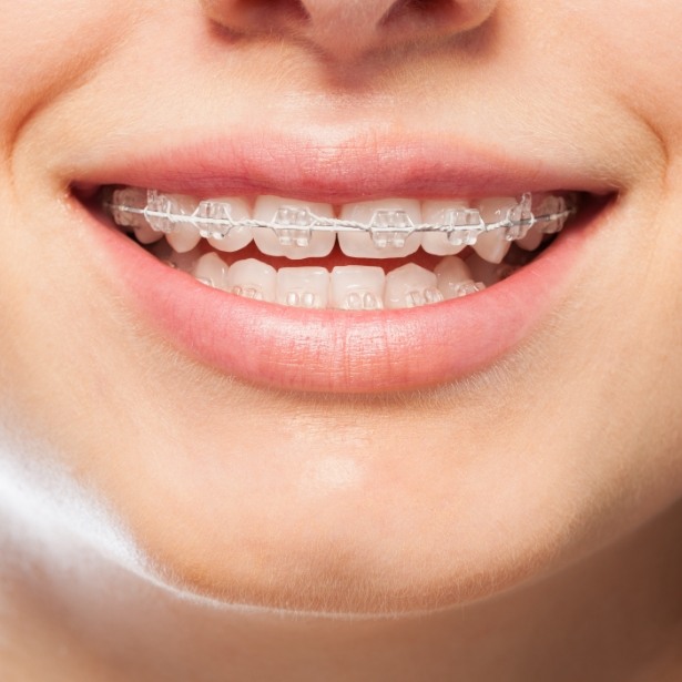 Closeup of smile with clear and ceramic braces