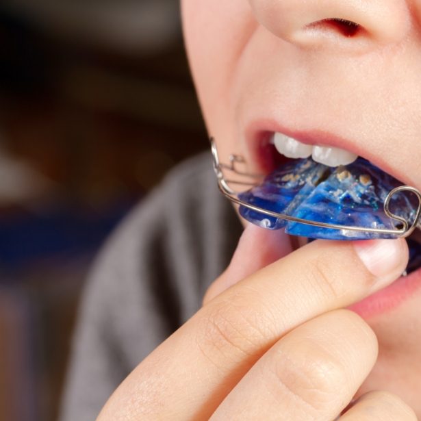 Closeup of patient placing an orthodontic appliance