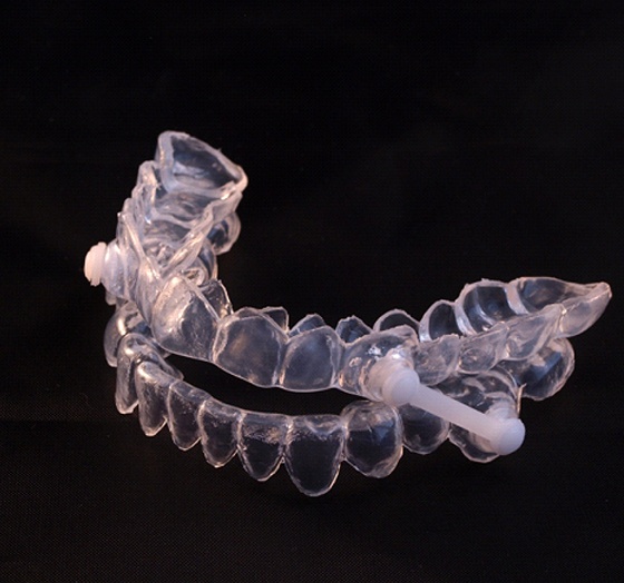 Close-up of oral appliance for sleep apnea in Palm Harbor, FL