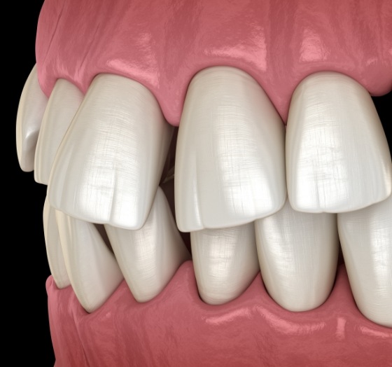 Animated smile with crooked teeth before traditional braces treatment