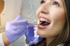 Woman smiling while getting braces in Palm Harbor