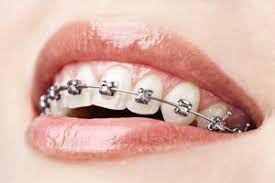 closeup of person with braces 