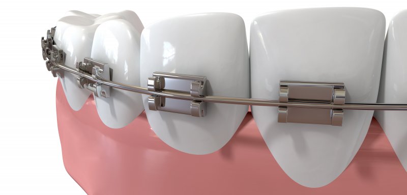 Close-up render of lower teeth with braces