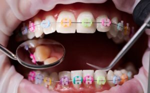 Close-up of rubber bands on braces
