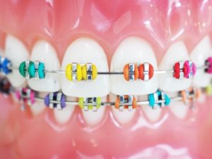 a closeup of braces with colored rubber bands